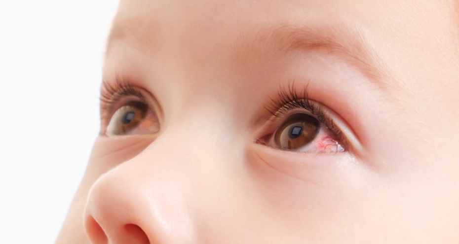 Occhi rossi nei bambini: riconoscere e curare le diverse forme di congiuntivite