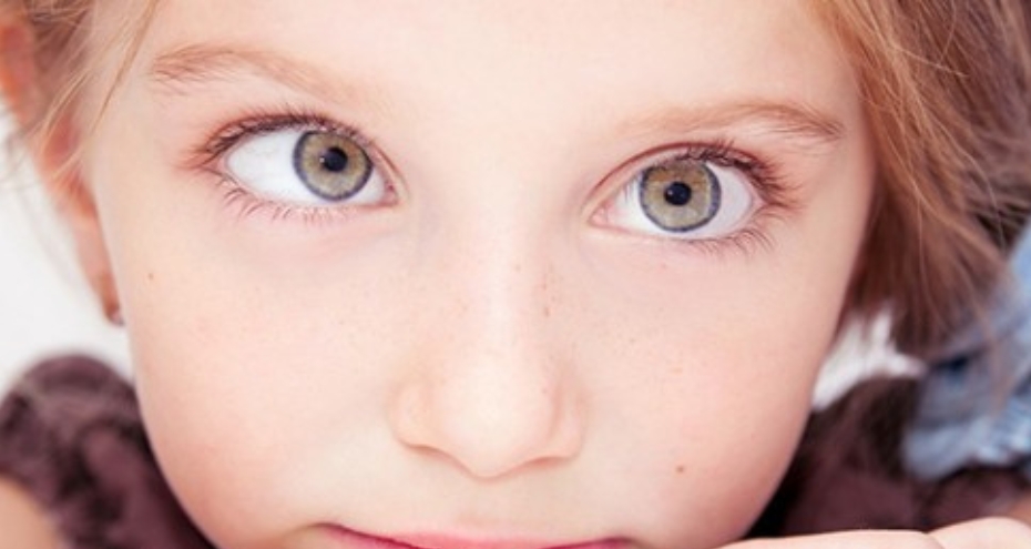 Strabismo nei bambini e negli adulti, le forme più comuni