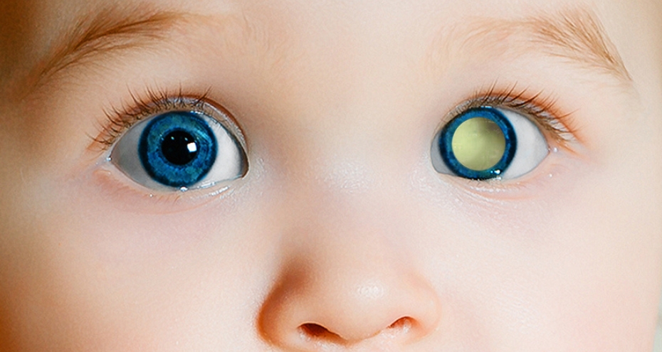 Perché è fondamentale eseguire l'esame del fondo oculare nel neonato