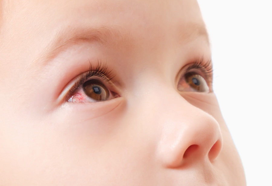L'occhio rosso nel bambino